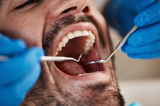 Best Emergency Dentist for Lost Fillings or Crowns in Sharpsburg, NC